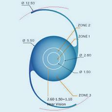 Polymethyl Methacrylate Multifocal Lens