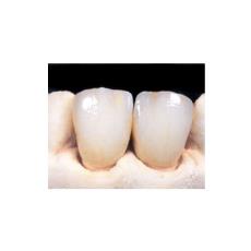 Metal Free Dental Crown