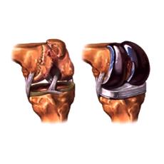 Medical Grade Knee Implant